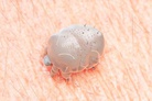 British life-style: Doctors report ‘nightmare’ surge in scabies across UK